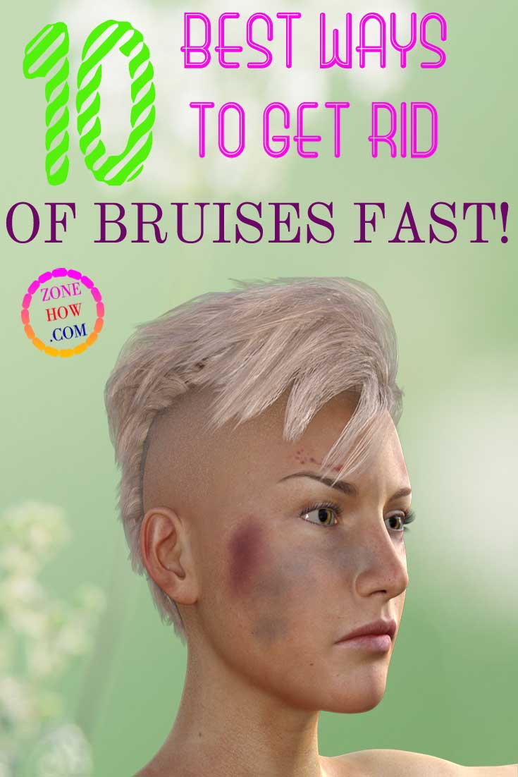 10 best ways to get rid of bruises