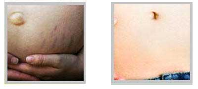 Laser Treatment for Stretch Marks Removal