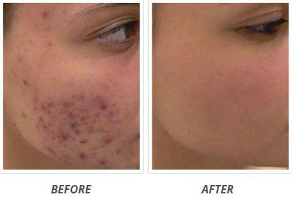 ArteFill For Acne Scars – Can it Be Used?