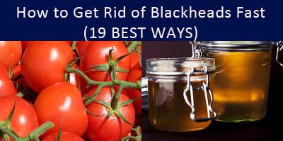 How to Get Rid of Blackheads Fast at Home (19 BEST TIPS)